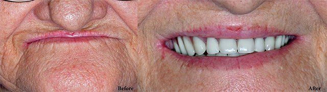 Dentures Before - After done by Dr. Toups in Lafayette, La