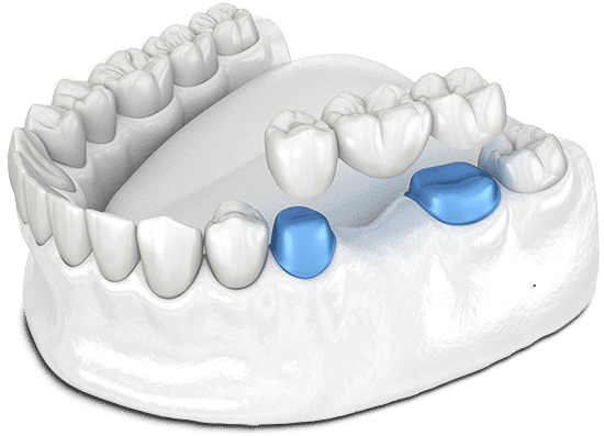 Dental Bridges