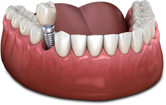 Dental Implants