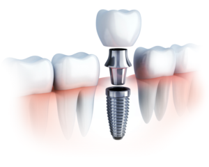 Dental Implants