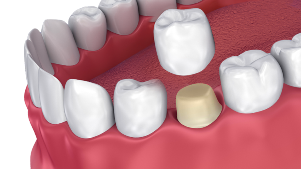 Dental Crowns