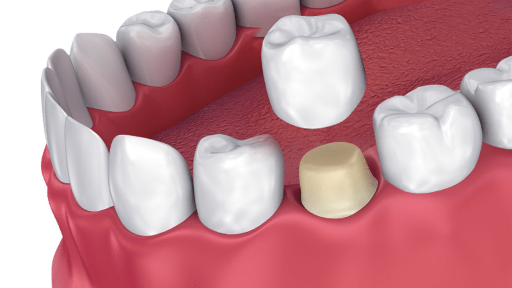 Affordable Dental Crowns Toups Family Dentistry 3372377005